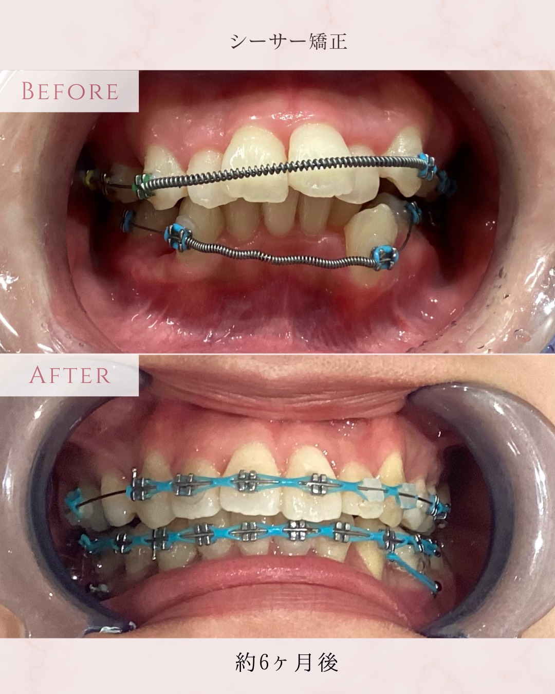 矯正治療メニュー
