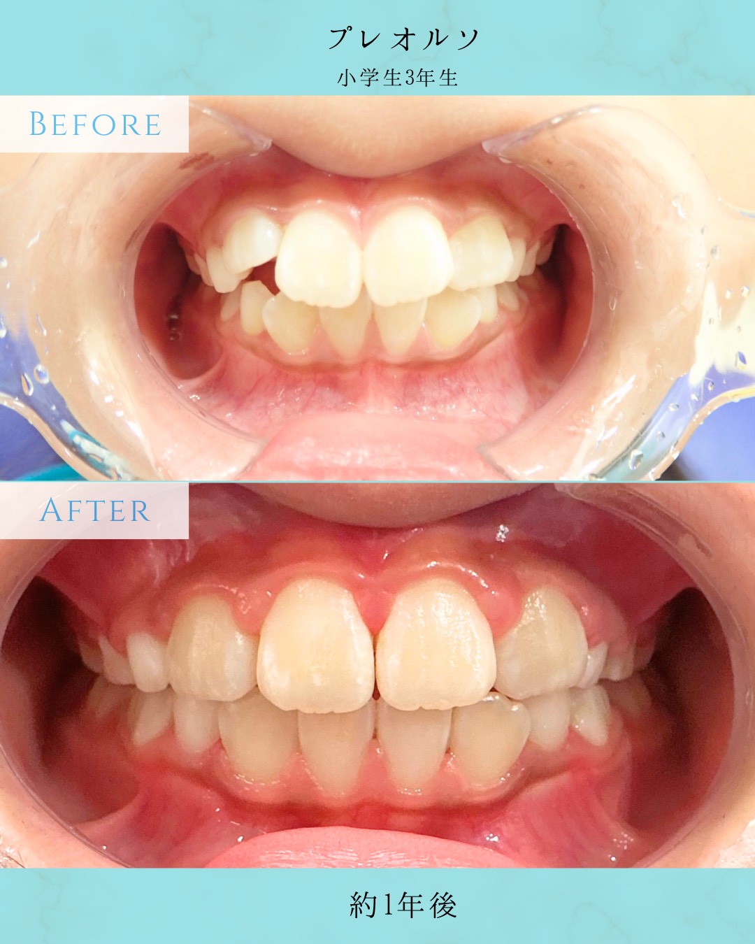 矯正治療メニュー